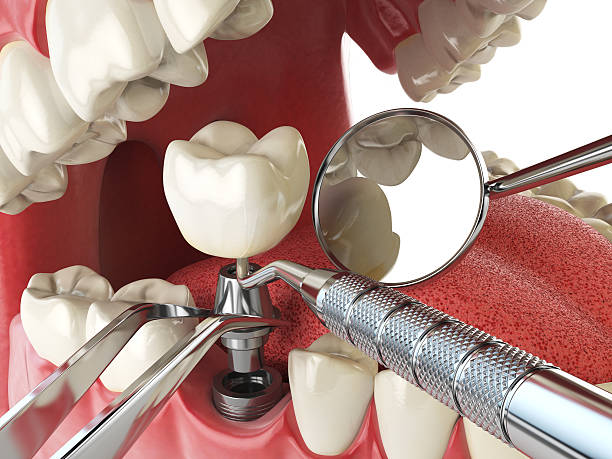 Best Emergency Dental Care for Broken or Chipped Teeth in Logan, UT